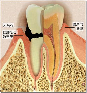 牙结石引起牙龈萎缩怎么办